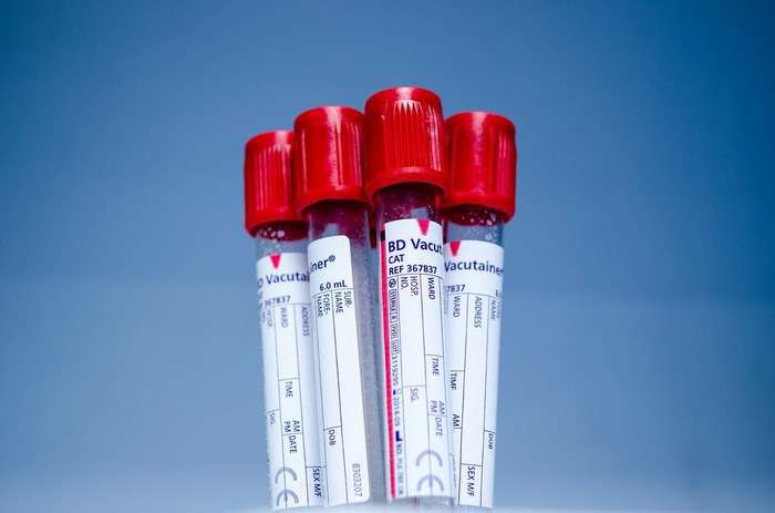 Infarto e ictus: un nuovo esame del sangue può predirne il rischio